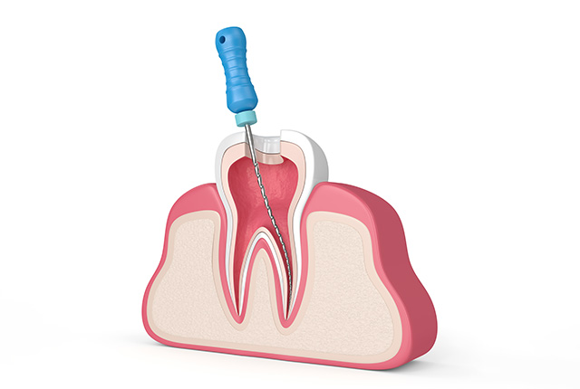 根管治療のイメージ図