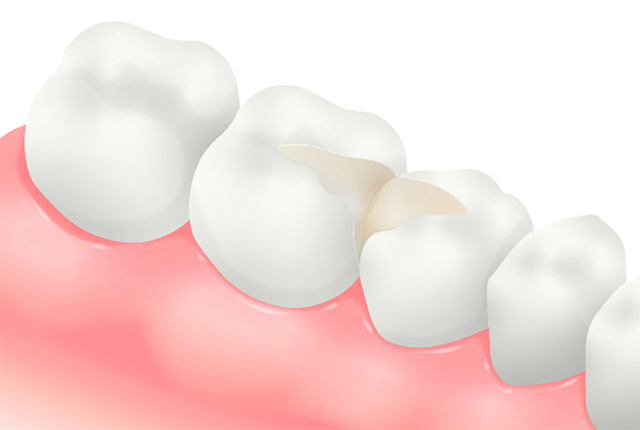 詰め物のイメージ図