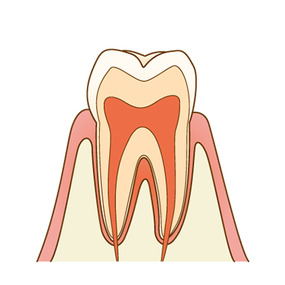 根管治療前イメージ図