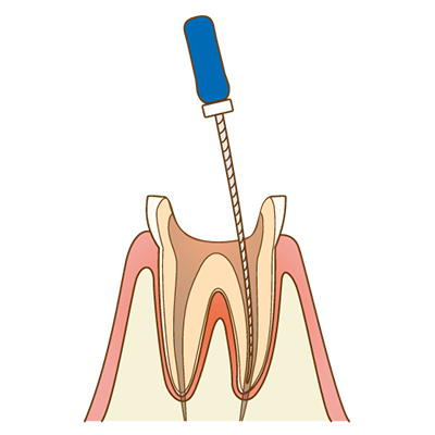 虫歯の除去・根管治療のイメージ図