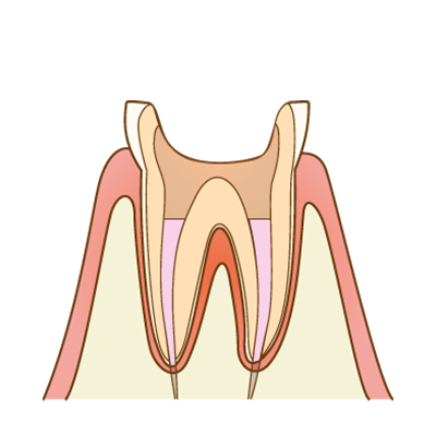 根管の緊密な充填のイメージ図