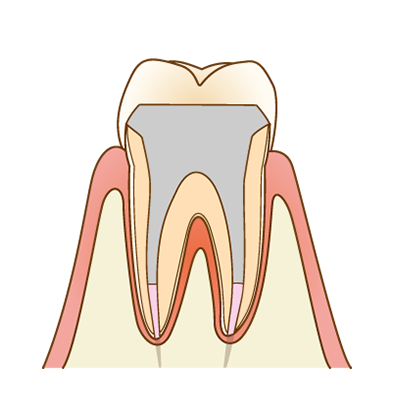 土台（コア）の作製のイメージ図