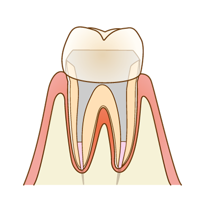 補綴修復（被せ物）をしたイメージ図