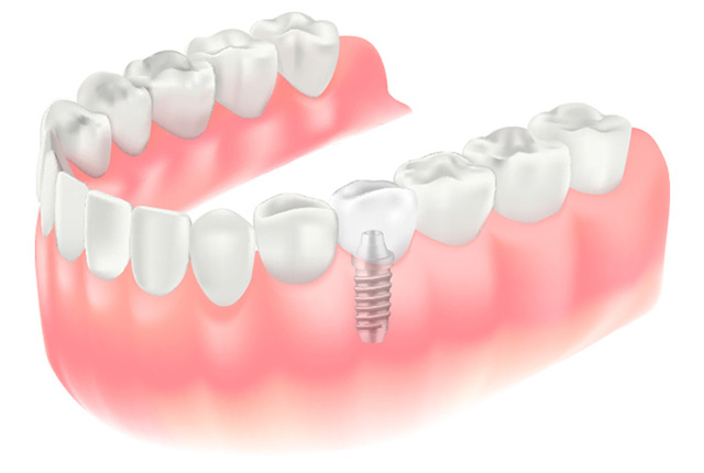 インプラントのイメージ図