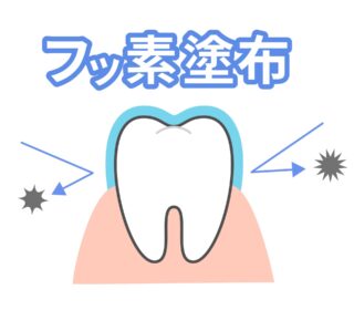 フッ素塗布とシーラント